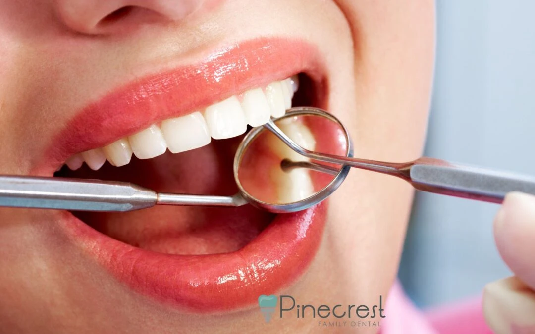 Cosmetic Dental Bonding in Pinecrest, FL